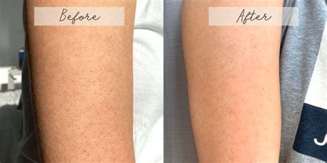 What Is Keratosis Pilaris? – Evolve Organic Beauty