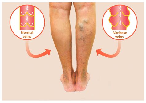 Home Treatments For Varicose Veins - The Vein Company