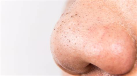 What Are Blackhead Pimples Actually Made of, and What's Inside? | Allure