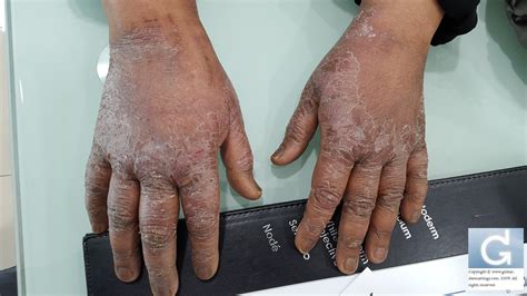 Evzema On Hands / SLIDESHOW - The many faces of eczema in hands! | Hand ...