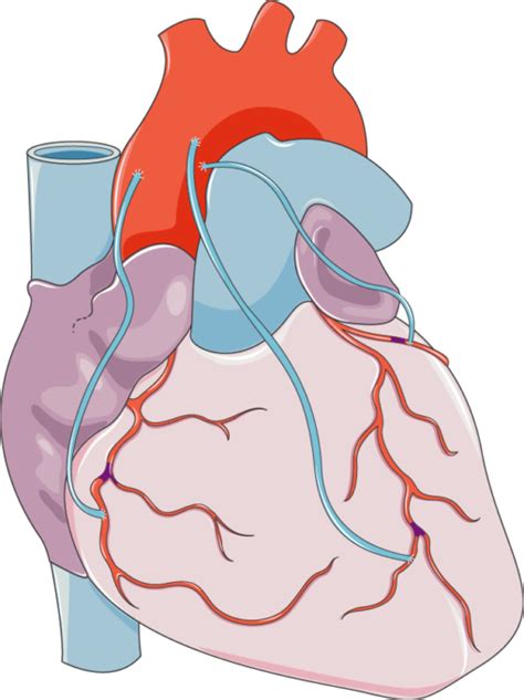 Coronary Artery Bypass Grafting - Servier Medical Art