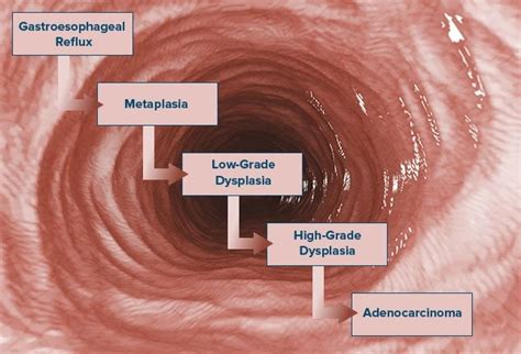 Staging Of Esophageal Cancer