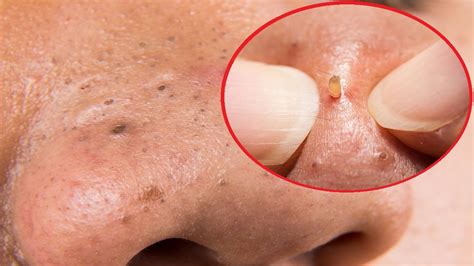 Here's How to Remove Blackheads on Your Nose - YouTube