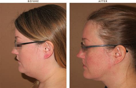 Liposuction of the Neck - Before and After Pictures | Dr Turowski ...