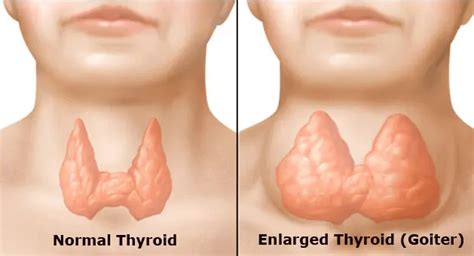 Goiter - Causes, Symptoms, Treatment, Diagnosis, Diet - Why Thyroid