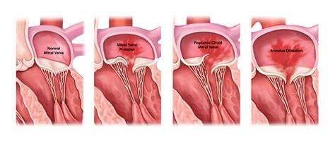 Mitral Valve Regurgitation Causes, Symptoms & Treatment