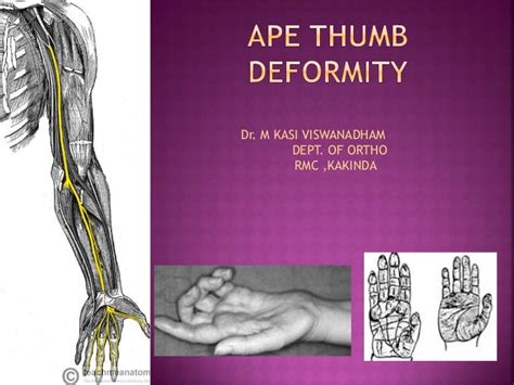 Ape thumb deformity to publish