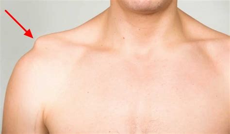 AC Joint Separated Shoulder Pain – Strong AID