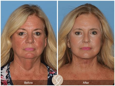 Deep Plane Facelift & Deep Plane Necklift Case 2 Before After Photos ...