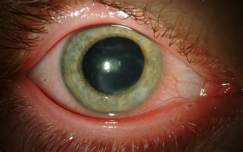 Red Ring Around Iris, Eyelids, Eye Socket, In Babies & More - American ...