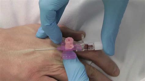 Cannulation- How to gain IV access - YouTube