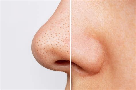 Blackhead Treatments | London