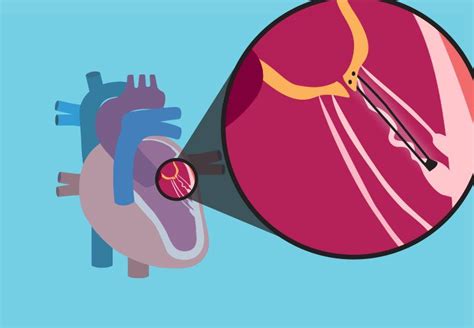 New Treatment for Leaky Mitral Valves | Mitral valve, Mitral valve ...