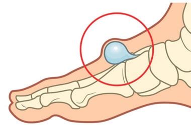 Lump On Top Of Foot: Common Causes & Treatment