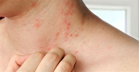 Living with Dermatitis: Types, Causes, and Treatment – Advanced Skin ...