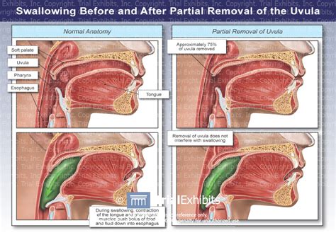 Swallowing Before and After Partial Removal of the Uvula - TrialQ...