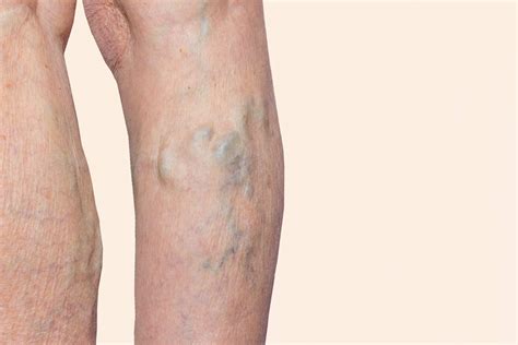 How Do Doctors Test And Diagnose Varicose Veins?