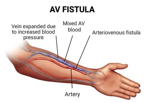 Percutaneous AV Fistula Creation Success | Interventional Radiology ...