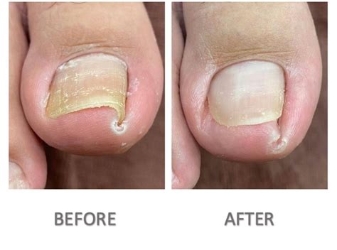 Ingrown Toenail Surgery - Professional & reliable Chiropodist