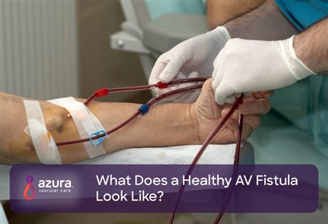 What Does a Healthy AV Fistula Look Like? | Azura Vascular Care