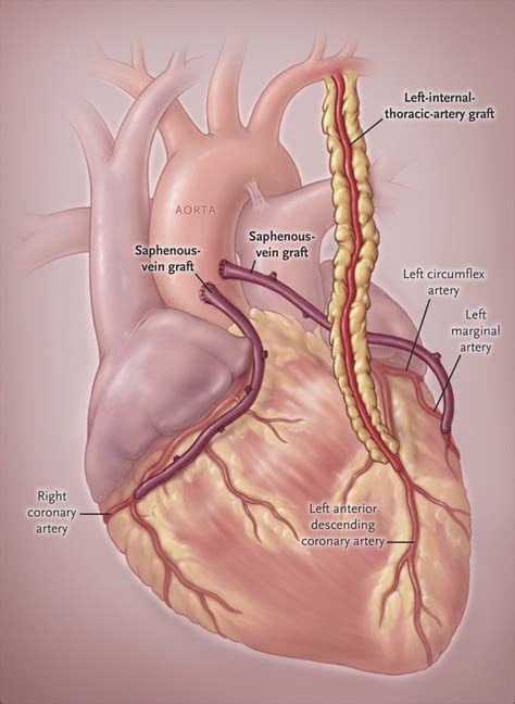 Coronary-Artery Bypass Grafting | NEJM