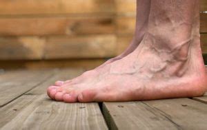 Understanding Bone Spurs on Top of Foot: Causes and Treatments