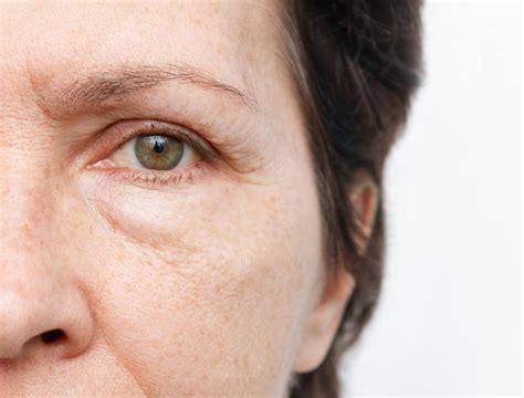 Bags under eyes | Symptoms & Causes | Skin Institute