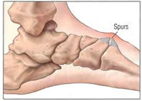 Остеофит Пяточной Кости Фото – Telegraph