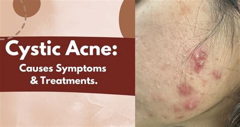 Cystic Acne: Causes, Symptoms and Treatment | Dr. Pallavi Sule