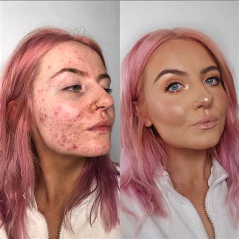 This foundation is going viral after cystic acne sufferer shares her ...