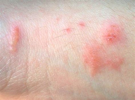 Urushiol-induced contact dermatitis - Wikipedia