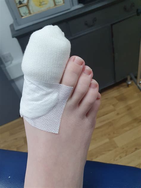 What happens during toenail surgery? - West Berkshire Foot Clinic