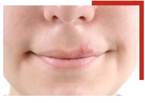 Herpes Simplex Virus - Sutton Dermatology + Aesthetics Ctr