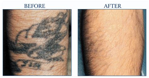 Ready To Lose The Faded Tattoo | North Houston Laser Tattoo Removal