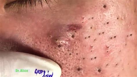 Newest Blackhead Removal Videos 2024 – Youtube - Eula Laurella