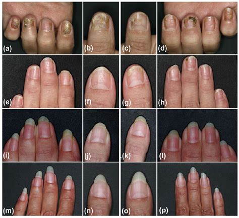 Ridges In Fingernails Psoriasis at Laura Chamberlain blog