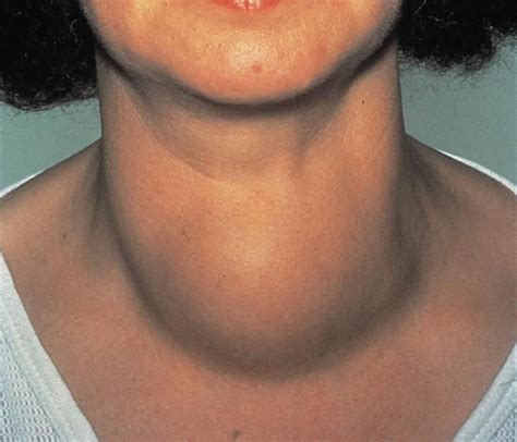 TREATMENTS FOR THYROID GOITER - Thyroid Cure Tips