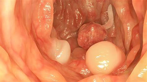 Treatment Options For Bowel Polyps - Ask The Nurse Expert