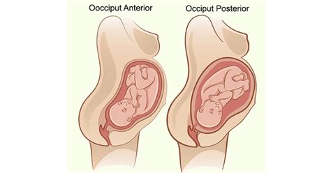 Course And Management Of Labour - Deep Transverse Arrest (Dta) Archives ...