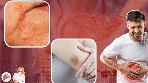 Liver Cirrhosis Symptoms: 9 Warning Skin Signs of Liver Disease You ...