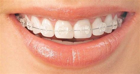 Why Clear Braces Are Great For You? - Health and Healthy Tips