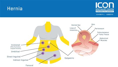 Hernia — Icon Specialist Centre