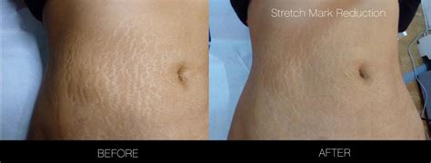 How To Get Rid Of Stretch Marks | Toronto | SpaMedica