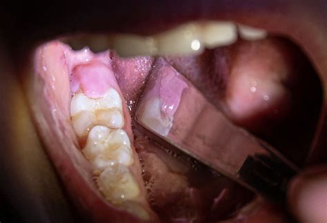 5 Effective Tips To Reduce Swelling Over Wisdom Teeth – A Guide To ...