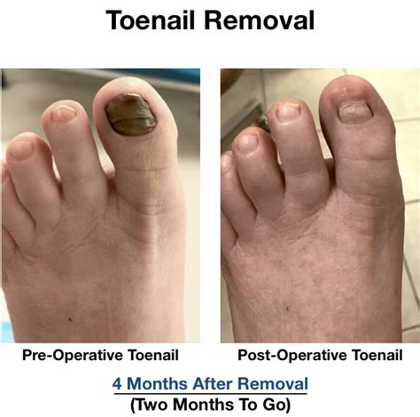 Fungus Toenail Removal