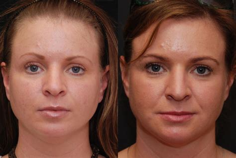 Facial Liposuction Photos | Cincinnati, OH | Patient 6846