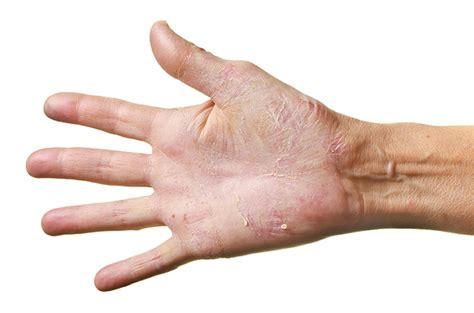 New study shows hand eczema is more common among healthcare workers