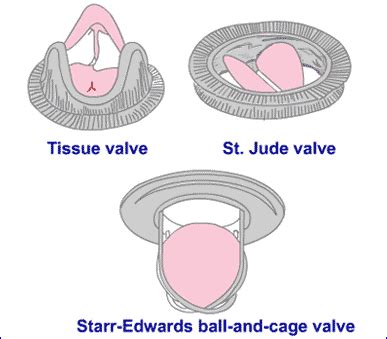 Mitral Valve replacement