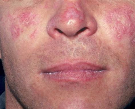 Lupus - Systemic Lupus Erythematosus (SLE) - Causes, Sign & Symptoms