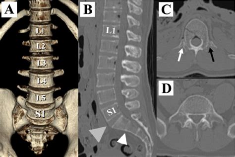 Figure 4 from The association between lumbar rib and lumbosacral ...